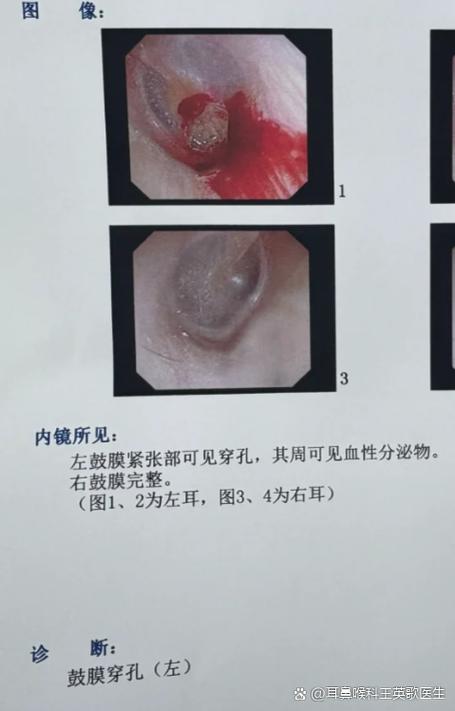 儿童耳朵出血是什么原因导致的？需要立即就医吗？-第1张图片-郑州医学网
