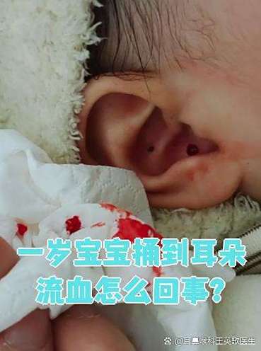 儿童耳朵出血是什么原因导致的？需要立即就医吗？-第2张图片-郑州医学网