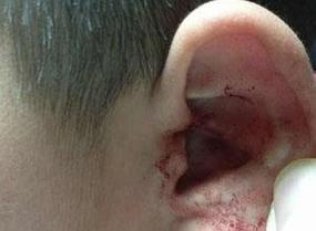 儿童耳朵出血是什么原因导致的？需要立即就医吗？-第3张图片-郑州医学网