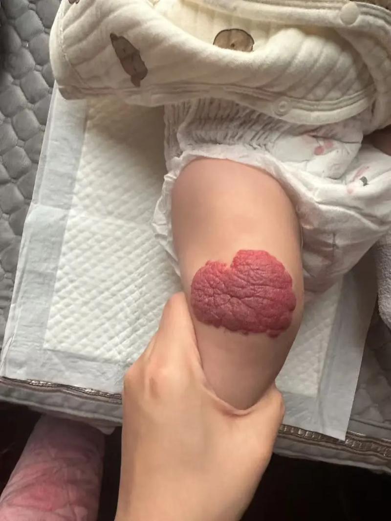 新生儿血管瘤究竟多久才会自行消退?家长又该如何科学应对?-第1张图片-郑州医学网 新生儿血管瘤究竟多久才会自行消退?家长又该如何科学应对?-第1张图片-郑州医学网