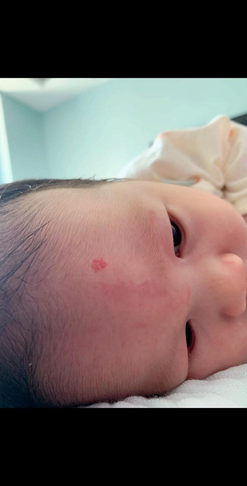 新生儿血管瘤究竟多久才会自行消退?家长又该如何科学应对?-第2张图片-郑州医学网 新生儿血管瘤究竟多久才会自行消退?家长又该如何科学应对?-第2张图片-郑州医学网