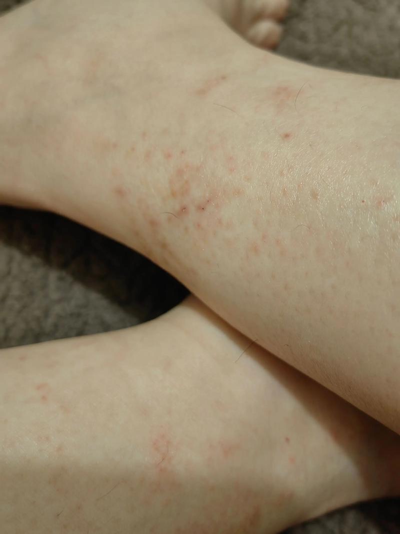 孕期脚脖子痒，是皮肤问题还是激素变化？需要警惕哪些孕期特殊疾病？-第1张图片-郑州医学网