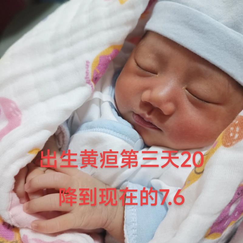 新生儿黄疸喝玉米须水-第2张图片-郑州医学网