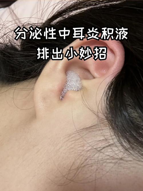 儿童中耳积液怎么治疗-第2张图片-郑州医学网