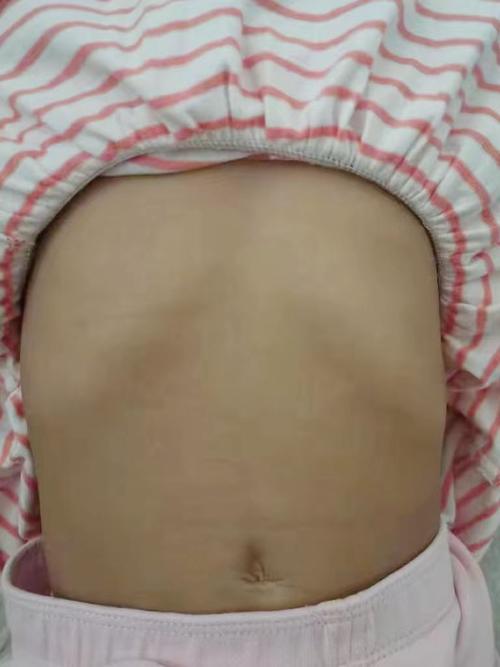 儿童左胸骨头突出是正常生理现象还是疾病征兆？附图片对比解析。-第2张图片-郑州医学网