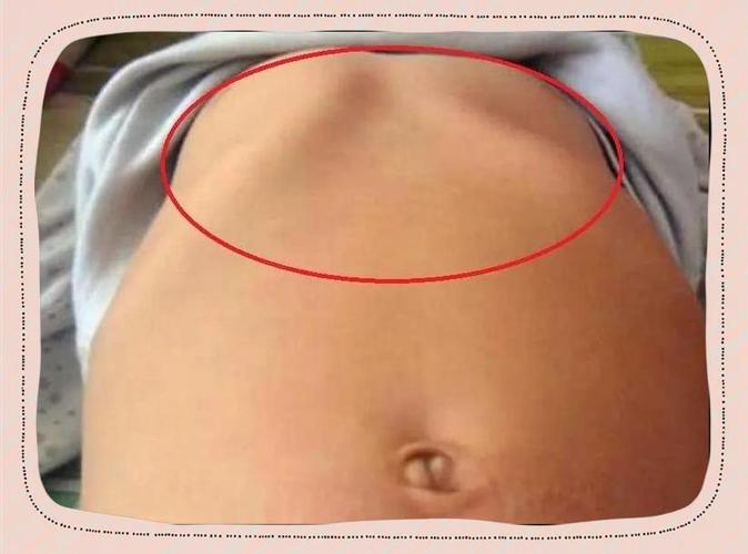 儿童左胸骨头突出是正常生理现象还是疾病征兆？附图片对比解析。-第1张图片-郑州医学网