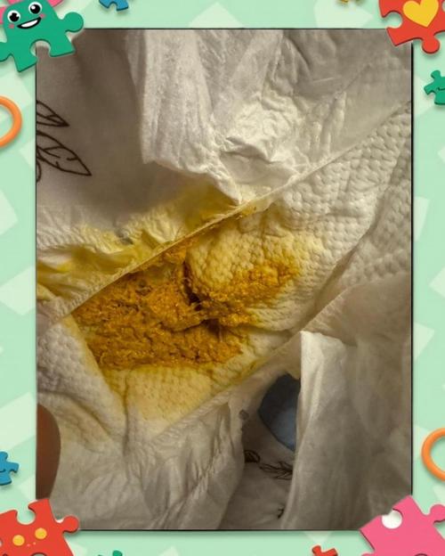 新生儿拉屎有奶瓣酸臭-第3张图片-郑州医学网