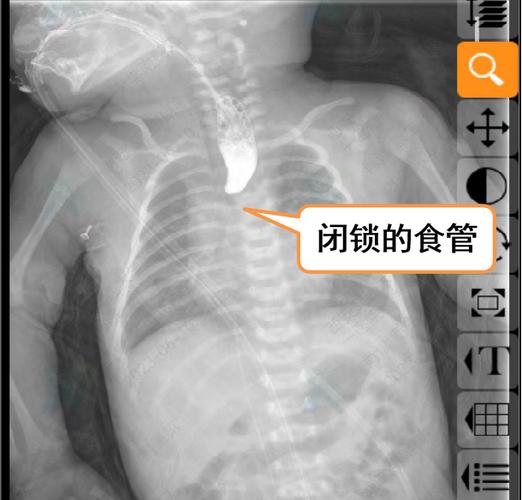 新生儿消化道造影危害-第1张图片-郑州医学网