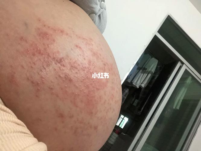 孕期肚皮突然起红点又痒，是皮肤过敏还是妊娠特有疾病？-第2张图片-郑州医学网