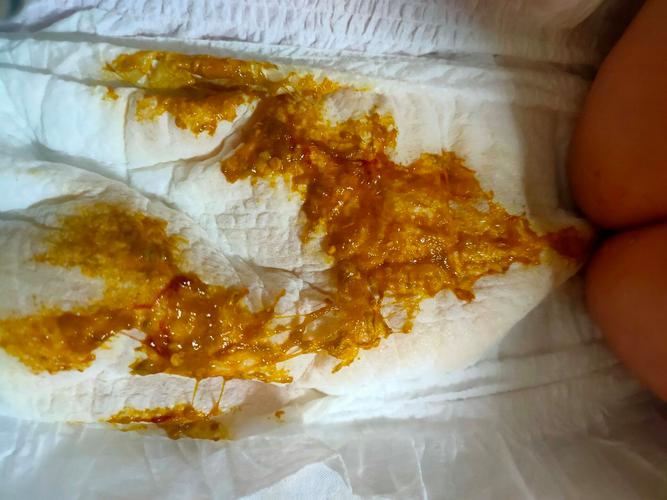 新生儿血培养粪肠球菌-第1张图片-郑州医学网