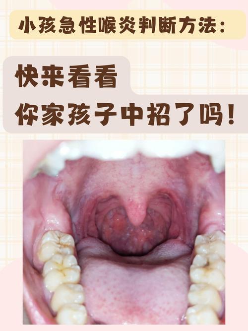 儿童正常喉咙图片大全,不同年龄段喉咙形态有何差异?-第1张图片-郑州医学网 儿童正常喉咙图片大全,不同年龄段喉咙形态有何差异?-第1张图片-郑州医学网