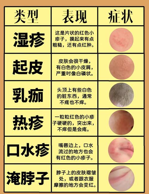 儿童夏季湿疹频发，日常护理与饮食调理有哪些关键措施？-第1张图片-郑州医学网