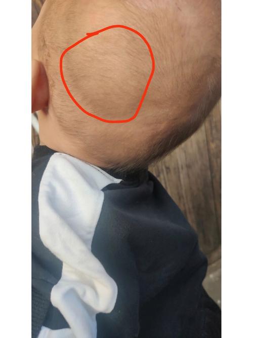 新生儿头上摸到硬筋疙瘩是正常现象吗？需要担心吗？-第2张图片-郑州医学网