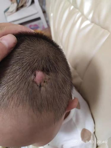 新生儿头上摸到硬筋疙瘩是正常现象吗？需要担心吗？-第3张图片-郑州医学网