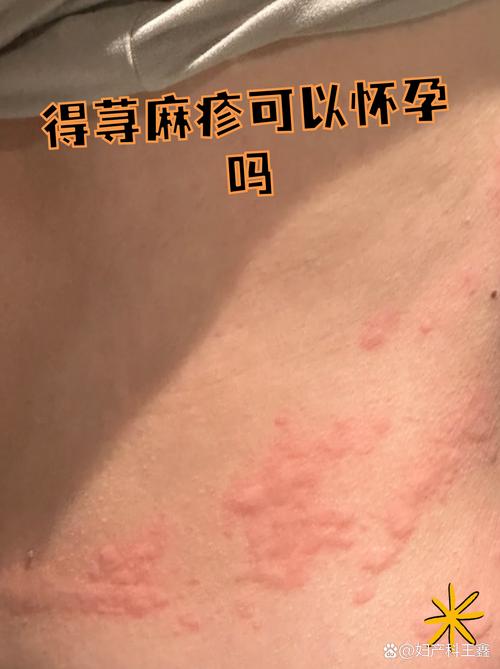 孕期荨麻疹会否影响胎儿健康？该如何科学应对保障母婴安全？-第3张图片-郑州医学网