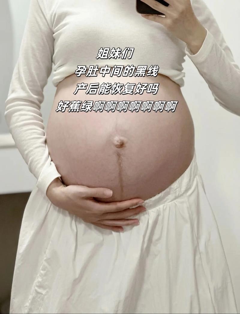 孕期肚子上的黑线不直是胎儿发育异常的信号吗？-第1张图片-郑州医学网