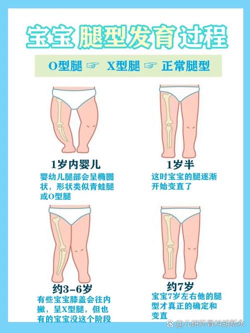 新生儿婴儿正常腿型图包含哪些阶段?不同月龄腿型标准是什么?-第1张图片-郑州医学网 新生儿婴儿正常腿型图包含哪些阶段?不同月龄腿型标准是什么?-第1张图片-郑州医学网