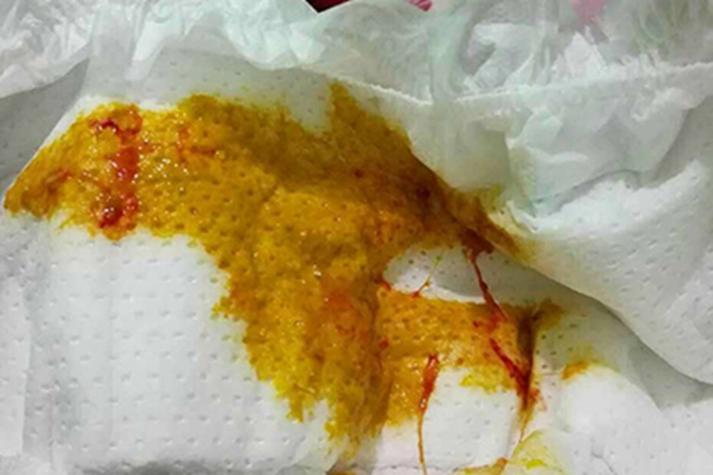 新生儿细菌性肠炎便血,该如何科学应对与护理?-第1张图片-郑州医学网 新生儿细菌性肠炎便血,该如何科学应对与护理?-第1张图片-郑州医学网