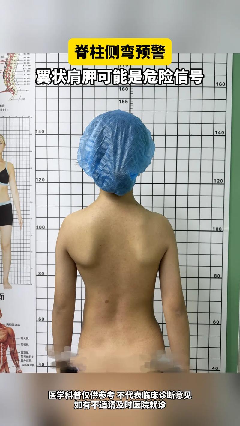 儿童肩胛骨突出是缺钙还是姿势问题?家长该如何科学应对?-第2张图片-郑州医学网 儿童肩胛骨突出是缺钙还是姿势问题?家长该如何科学应对?-第2张图片-郑州医学网