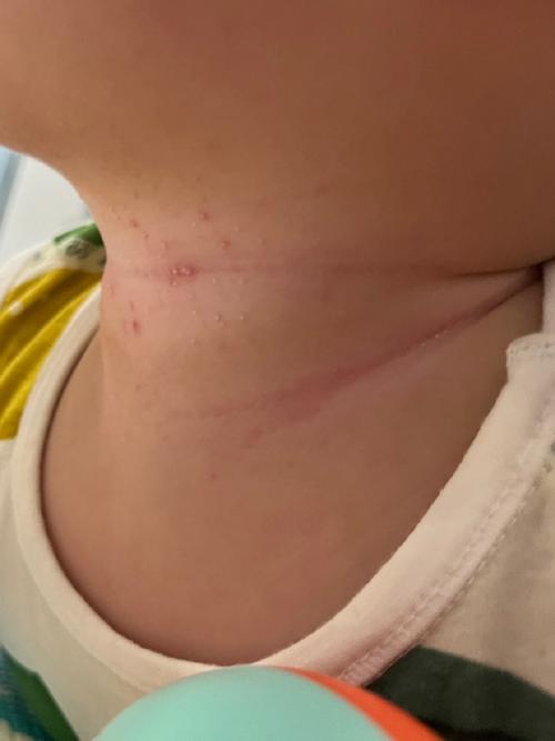 新生儿脖子后面有个包是正常现象吗？需要担心吗？应该怎么办？-第1张图片-郑州医学网