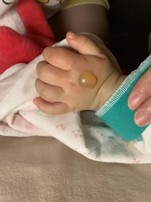 儿童被开水烫伤的图片为何能传播？家长该如何避免这种悲剧？-第1张图片-郑州医学网