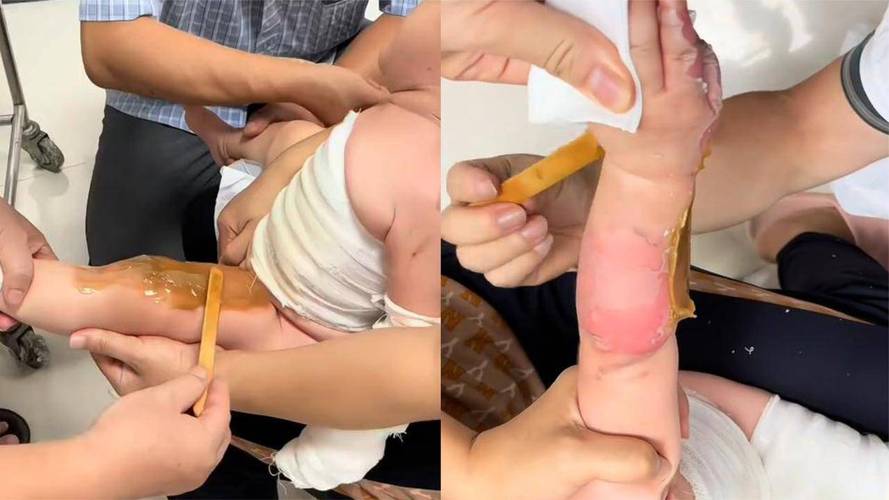 儿童被开水烫伤的图片为何能传播？家长该如何避免这种悲剧？-第2张图片-郑州医学网