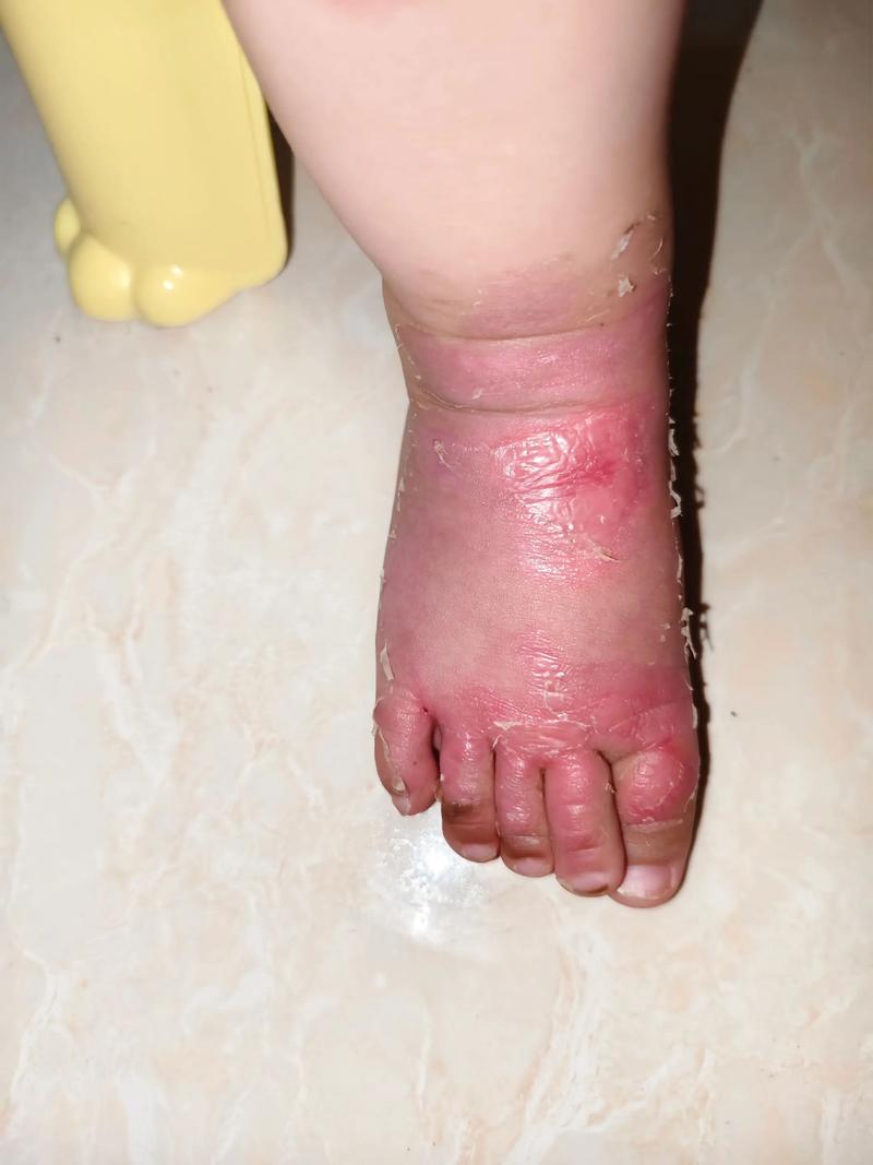 儿童被开水烫伤的图片为何能传播？家长该如何避免这种悲剧？-第3张图片-郑州医学网