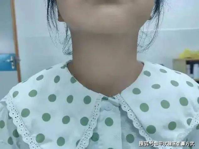 七岁儿童甲减早期症状有哪些？家长该如何早期识别与干预？-第1张图片-郑州医学网