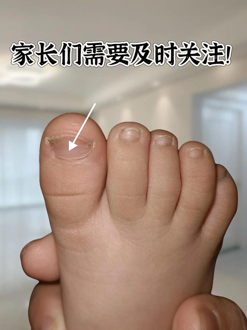 七岁儿童甲减早期症状有哪些？家长该如何早期识别与干预？-第3张图片-郑州医学网