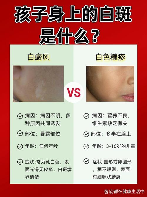 新生儿皮肤白就代表贫血吗?肤色与贫血到底有没有直接关联?-第2张图片-郑州医学网 新生儿皮肤白就代表贫血吗?肤色与贫血到底有没有直接关联?-第2张图片-郑州医学网