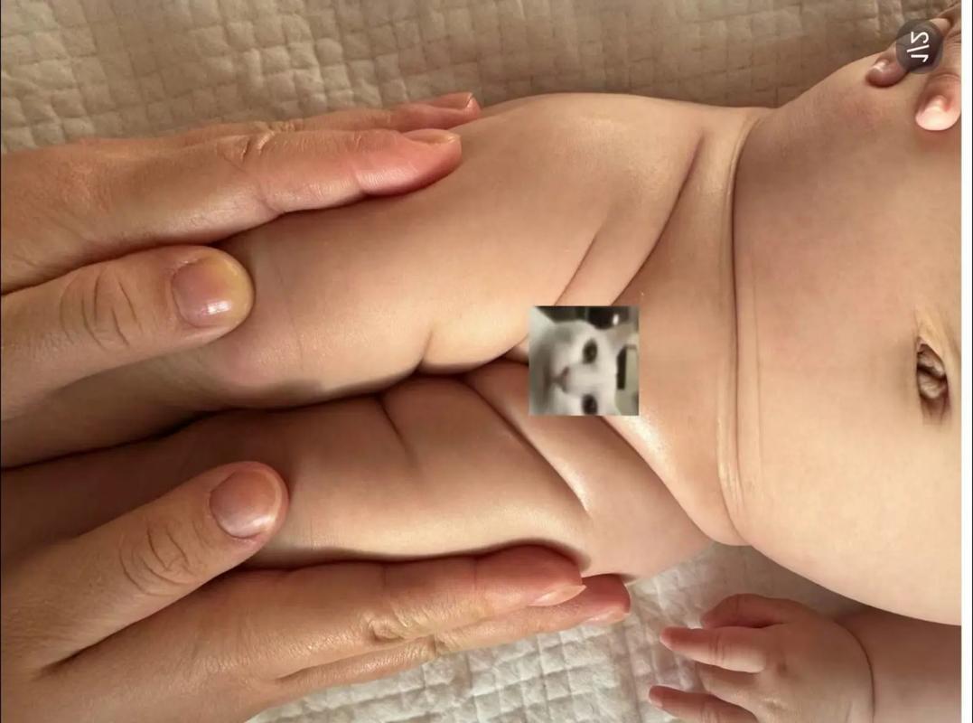 新生儿腿部纹理不对称是正常现象还是疾病信号？需警惕哪些潜在问题？-第1张图片-郑州医学网