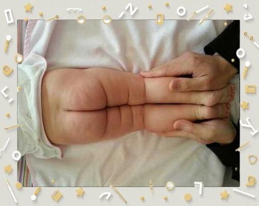 新生儿腿部纹理不对称是正常现象还是疾病信号？需警惕哪些潜在问题？-第2张图片-郑州医学网