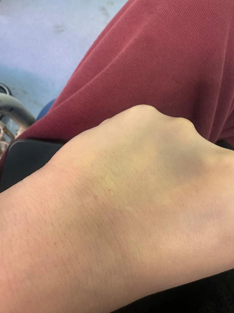 孕期手背青筋突然暴起是正常生理变化还是异常信号？需警惕哪些潜在风险？-第2张图片-郑州医学网