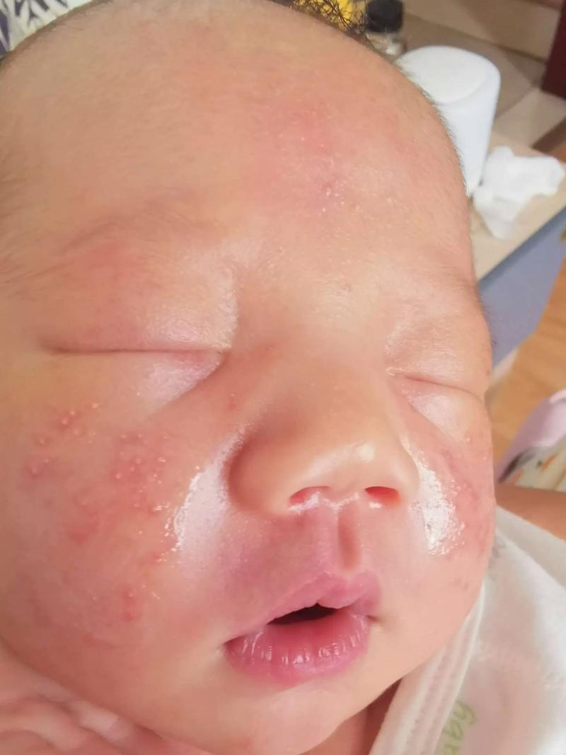 新生儿痤疮到底能不能用茶油治疗？茶油涂抹对宝宝皮肤安全吗？-第1张图片-郑州医学网