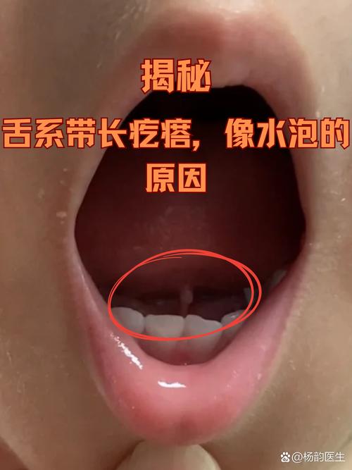 新生儿舌头上的小白点是什么？需要处理吗？对吃奶有影响吗？-第2张图片-郑州医学网