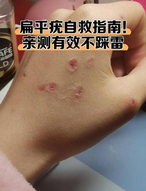 儿童扁平疣的最佳治疗方法有哪些?如何选择安全有效的治疗方式?-第1张图片-郑州医学网 儿童扁平疣的最佳治疗方法有哪些?如何选择安全有效的治疗方式?-第1张图片-郑州医学网