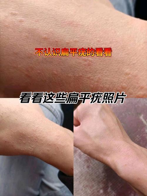 儿童扁平疣的最佳治疗方法有哪些？如何选择安全有效的治疗方式？-第2张图片-郑州医学网