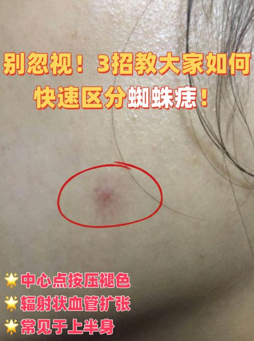 儿童蜘蛛痣的出现是疾病信号吗？需要警惕哪些潜在健康问题？-第1张图片-郑州医学网