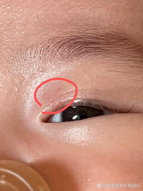 新生儿眼皮上长小红点是正常现象还是疾病信号？需要担心吗？-第1张图片-郑州医学网