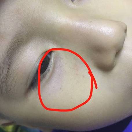 新生儿眼皮上长小红点是正常现象还是疾病信号？需要担心吗？-第2张图片-郑州医学网