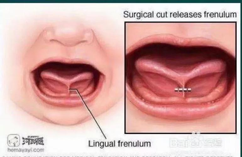 新生儿舌头大是正常现象还是疾病信号？需警惕哪些潜在问题？-第2张图片-郑州医学网