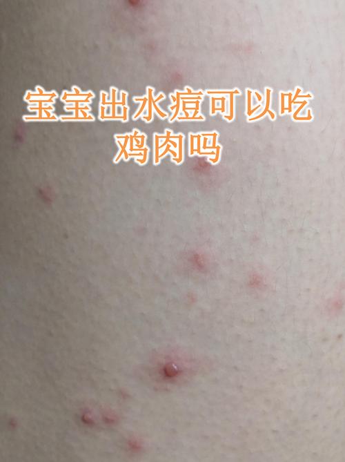 儿童出水痘期间饮食该注意什么？哪些食物能促进恢复？-第1张图片-郑州医学网