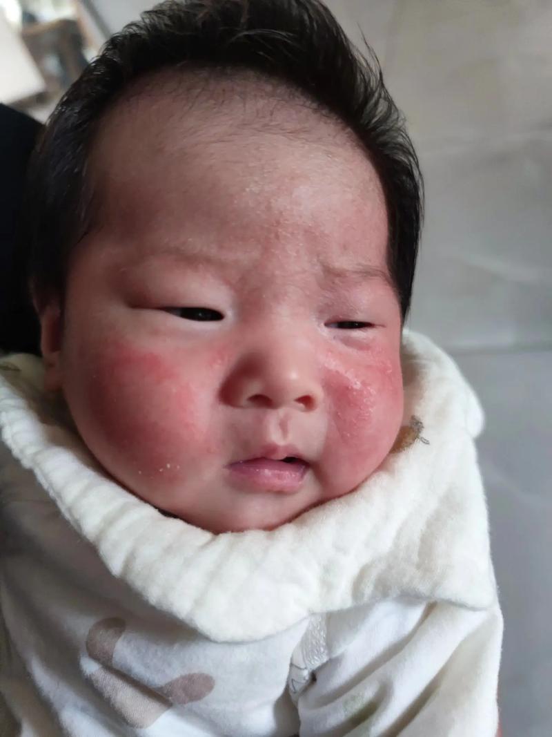 儿童脸上湿疹为何反复发作？日常护理与治疗需注意哪些关键点？-第1张图片-郑州医学网