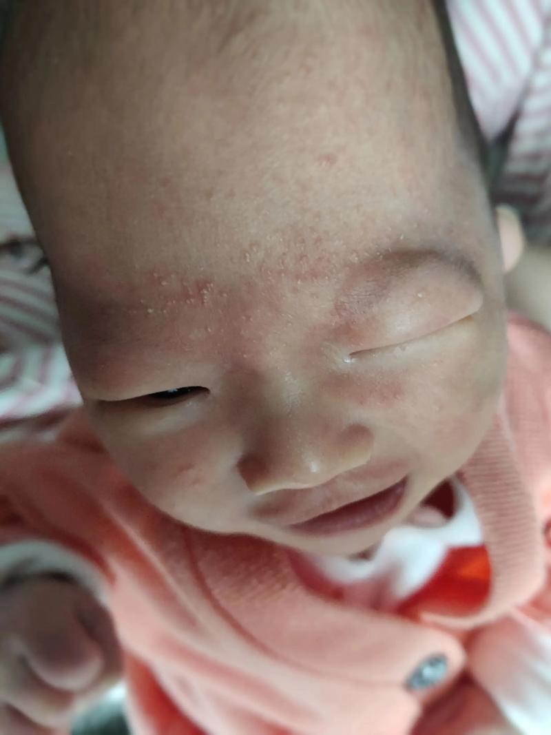 儿童脸上湿疹为何反复发作？日常护理与治疗需注意哪些关键点？-第2张图片-郑州医学网