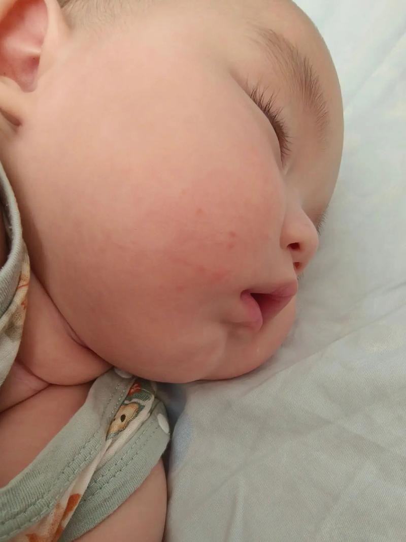 儿童脸上湿疹为何反复发作？日常护理与治疗需注意哪些关键点？-第3张图片-郑州医学网