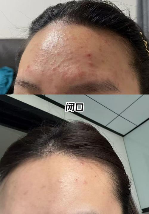 孕期脸上长闭合性粉刺-第2张图片-郑州医学网