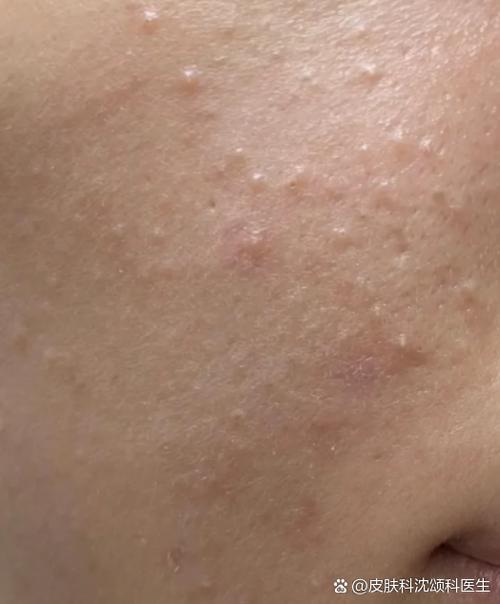 孕期脸上长闭合性粉刺-第1张图片-郑州医学网