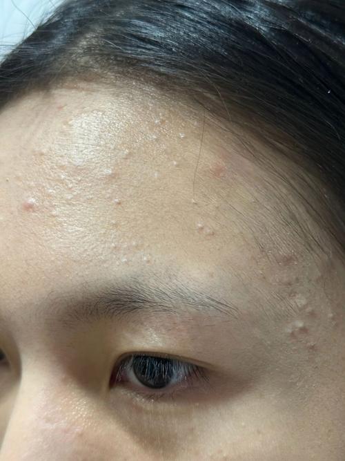 孕期脸上长闭合性粉刺-第3张图片-郑州医学网