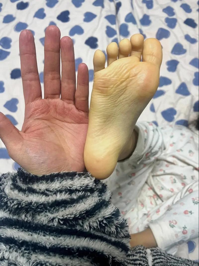 儿童皮肤发黄是营养不良还是肝脏疾病信号?需警惕哪些潜在原因?-第2张图片-郑州医学网 儿童皮肤发黄是营养不良还是肝脏疾病信号?需警惕哪些潜在原因?-第2张图片-郑州医学网