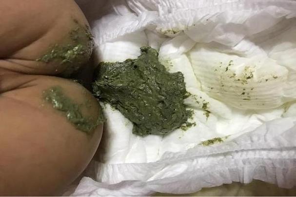 新生儿拉绿色便便是消化不良还是疾病信号?家长该如何应对?-第2张图片-郑州医学网 新生儿拉绿色便便是消化不良还是疾病信号?家长该如何应对?-第2张图片-郑州医学网